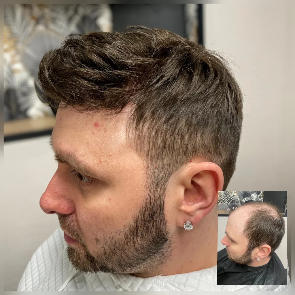 latelier-du-cheveu90 - photos avant et après d'un homme avec compléments capillaires